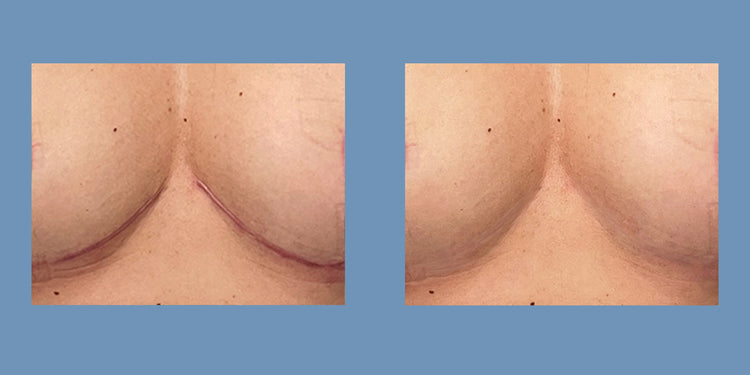 Scar Smooth™ Breast Scar Reducing Kit