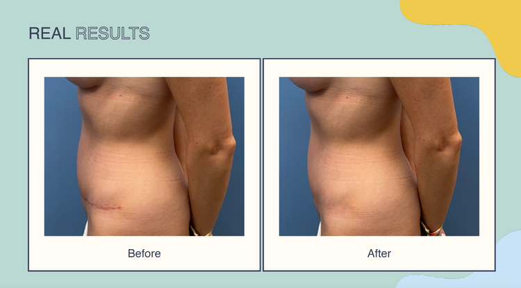 Scar Smooth™ Medical Grade Scar Reducing Kit - Compact