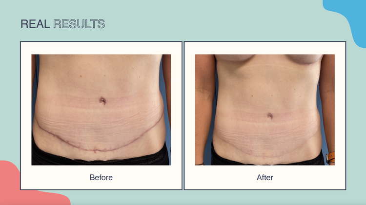 Scar Smooth™ Medical Grade Scar Reducing Kit - Pro