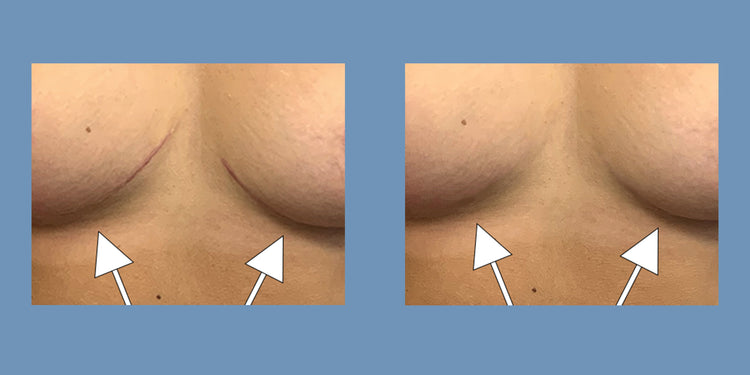 ScarSmooth™ Breast Scar Reducing Kit